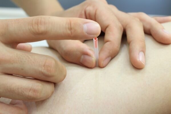 鍼治療